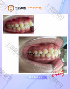 隐适美矫正前牙唇倾深覆盖