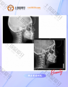 上牙弓狭窄，上下牙列重度拥挤