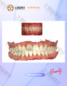 下颌牙列中度拥挤扭转
