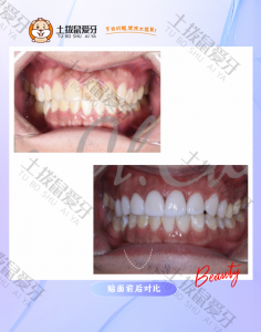 牙齿黄斑过多贴面隐藏