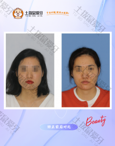 牙列高低不平咬合不佳