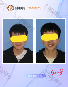 男生牙列不齐，个别牙反合，中线不齐正畸案例