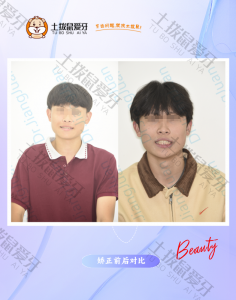 局部错颌反颌隐形矫正