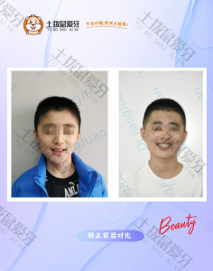 牙列不齐 青少年
