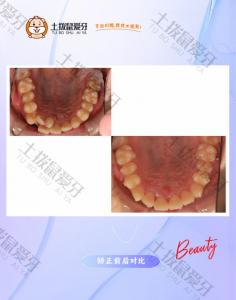 前牙个别牙反颌➕中线不齐