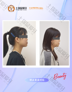 嘴突龅牙 女