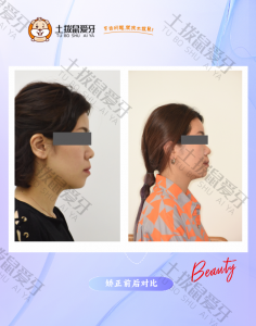 开颌对刃咬合不佳