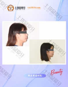 门牙斜突