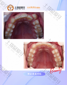 下巴后缩牙列拥挤