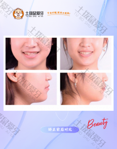 牙齿前突│开合│牙列不齐