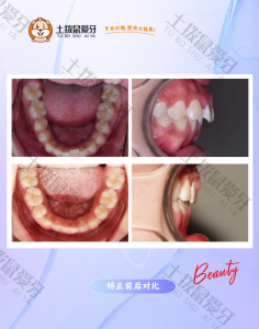 龅牙前突