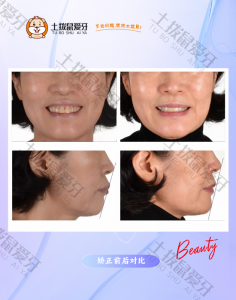 60岁女士矫正牙突深覆盖