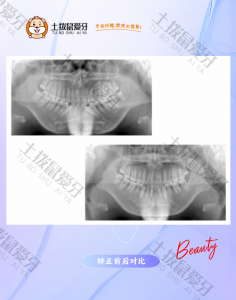 拔牙 隐形矫正牙列不齐