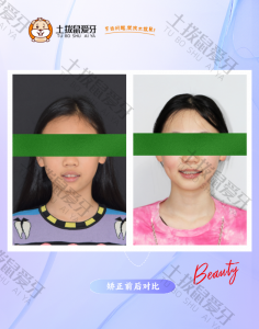 牙列上凸下缩