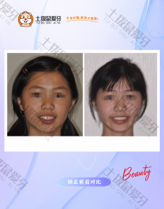 门牙外突 间隙明显