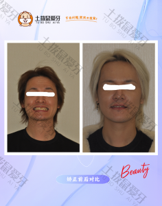 矫正成年男性反颌