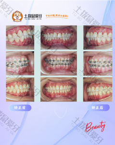 牙列不齐非拔牙推磨牙向后矫治