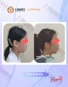 11岁，上牙前突，前牙深覆盖，金属牙齿矫正案例
