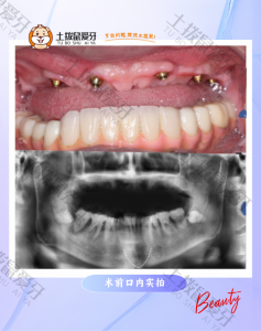 上颌半口种植 修复咬合