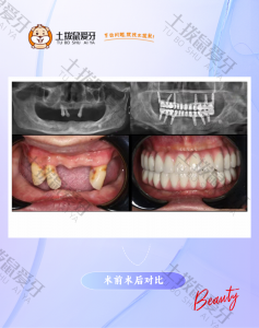 高龄高人全口缺失