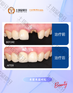 左上门牙折断，拔除种植，氧化锆全瓷冠修复。