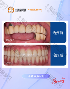 半口修复上颌牙列