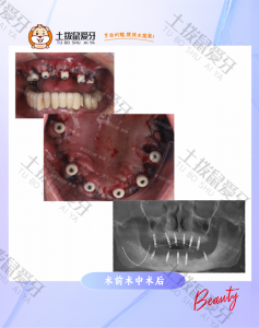 上前牙松动 下颌牙肿胀全口修复