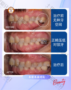 正畸种植联合治疗下颌6号牙