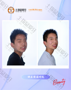 龅牙前突 牙列不正