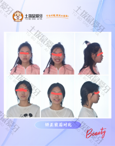 门牙扭转 前突 深覆盖