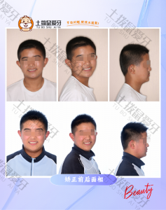 反颌 错合 对刃