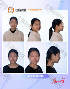 矫正 儿童门牙前突