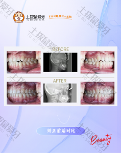 50岁牙齿不齐案例