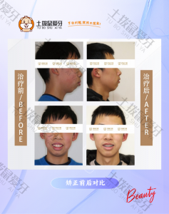深覆盖矫正案例