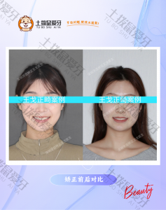 中切牙倾斜 矫正