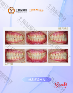 牙齿不齐矫正