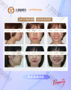 凸嘴、笑线不佳矫正案例