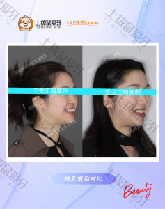 上下颌 前牙不正 