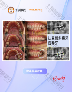 缺牙、牙齿倾斜，扶直倾斜磨牙后种牙矫正