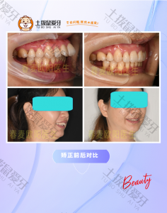 38岁女士龅牙矫正对比