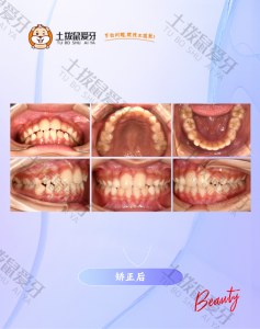 ETA佩戴18个月-口内照