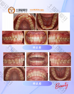 牙齿不齐，牙齿缝隙大隐形矫正