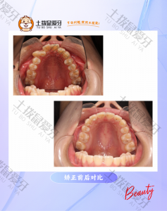 牙齿不齐金属托槽矫正