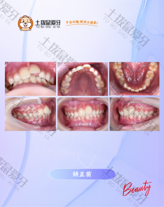 龅牙+深覆颌+中线不齐隐形矫正