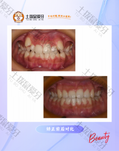 虎牙突出矫正