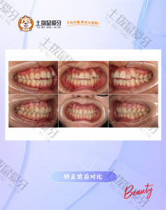 龅牙+虎牙突出+内倾型深覆颌矫正