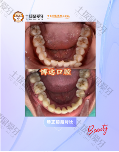 牙齿拥挤不齐矫正治疗