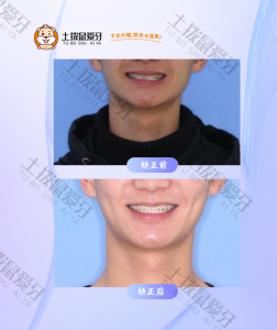 成人牙齿不齐