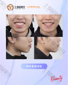 骨性前突