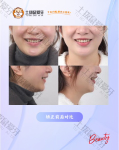 内倾型深覆合